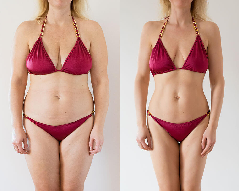 Phenocal - Befire After